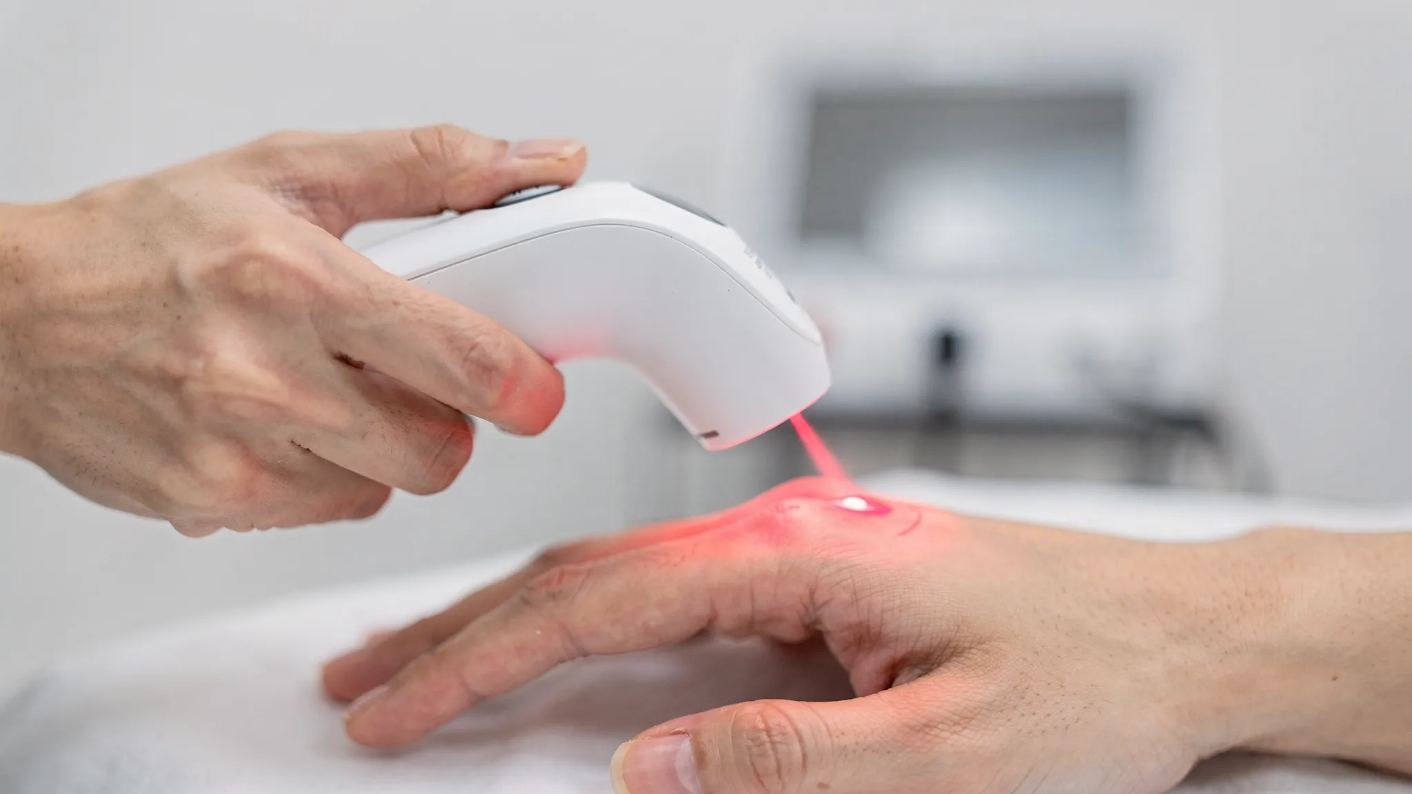 Aplicación de acupuntura láser con un dispositivo inalámbrico de mano (sin cables), emitiendo un haz rojo suave sobre un punto de acupuntura en la mano del paciente en un entorno clínico.