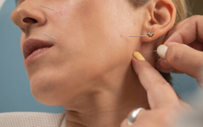 Acupuncture treatment for Bell’s palsy