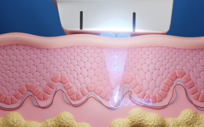 Ultherapy hifu laser treatment