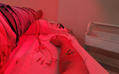 Therapist Giving electric acupuncture therapy via needle